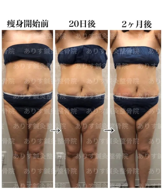 6センチ！！脂肪冷却2ヶ月後のお客様です☆ダイエットなら高松市