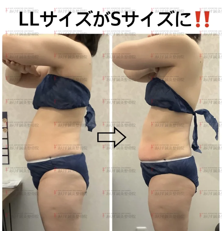 脂肪冷却③ わずか1カ月でLL→Sサイズに！！|痩身ダイエット脂肪冷却なら
