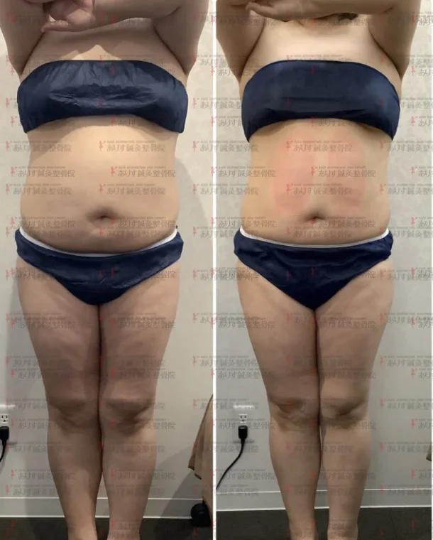 脂肪冷却 モニター様2カ月後のビフォーアフター♪|脂肪冷却なら高松市