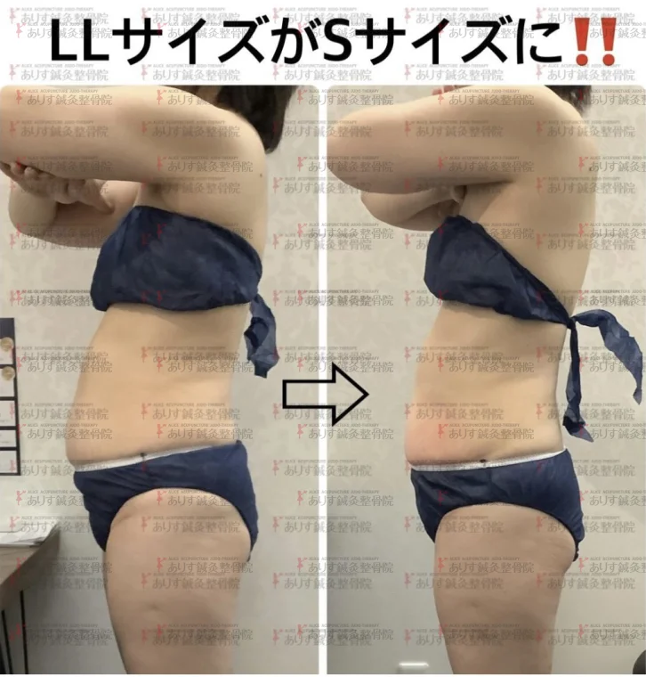 脂肪冷却③ わずか1カ月でLL→Sサイズに！！|痩身ダイエット脂肪冷却なら