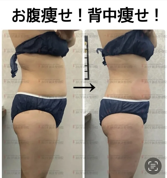 切らない脂肪吸引！？高松市のビューティーアリスで受けられる話題の