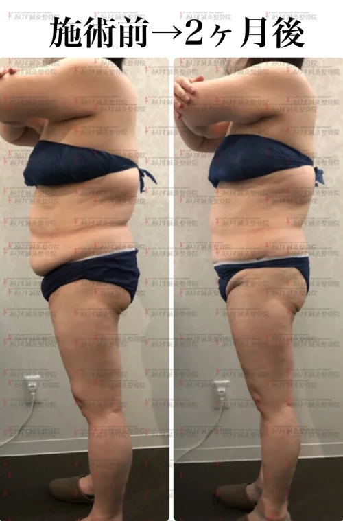 脂肪冷却で－7キロ！高松市でスピードダイエットしたい方必見